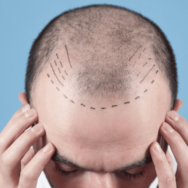 hair transplant loans