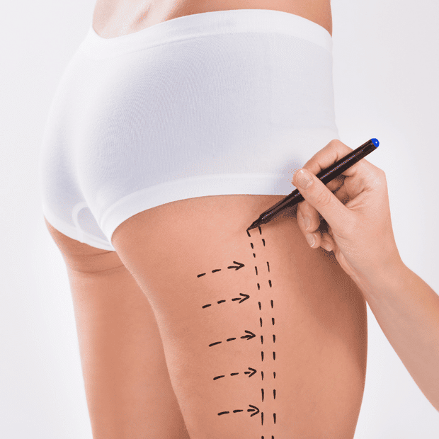 Liposuction financing